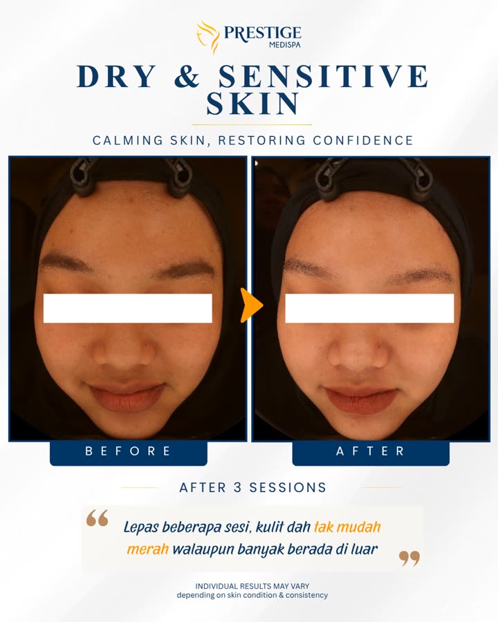 Sebelum dan selepas, kulit kering & sensitif