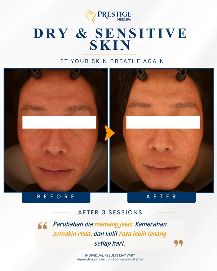 Sebelum dan selepas, kulit kering & sensitif