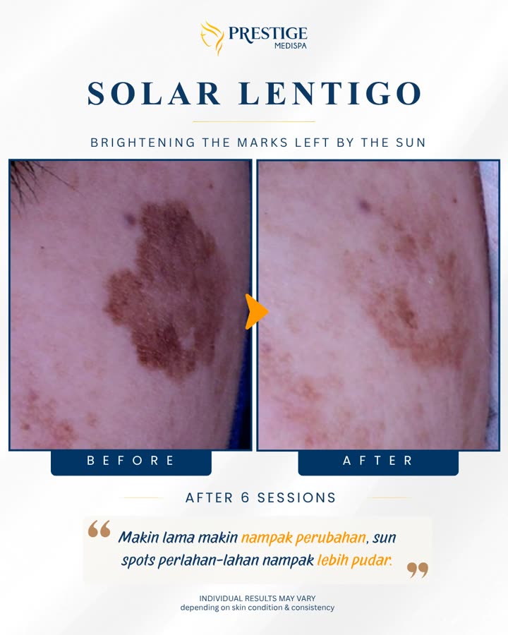 Sebelum dan selepas, solar lentigo